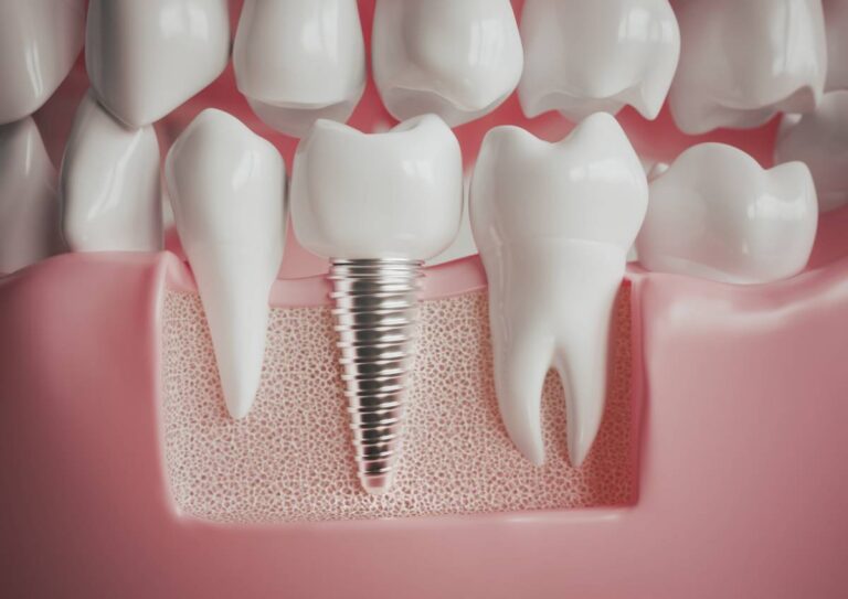 featured image for article on top reasons dental implants need to be removed