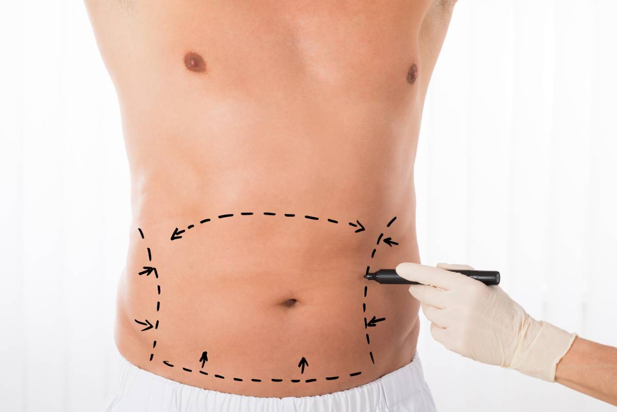 The image shows a gloved hand drawing correction lines on man's stomach. The image serves to represent what plastic surgery is right for men.