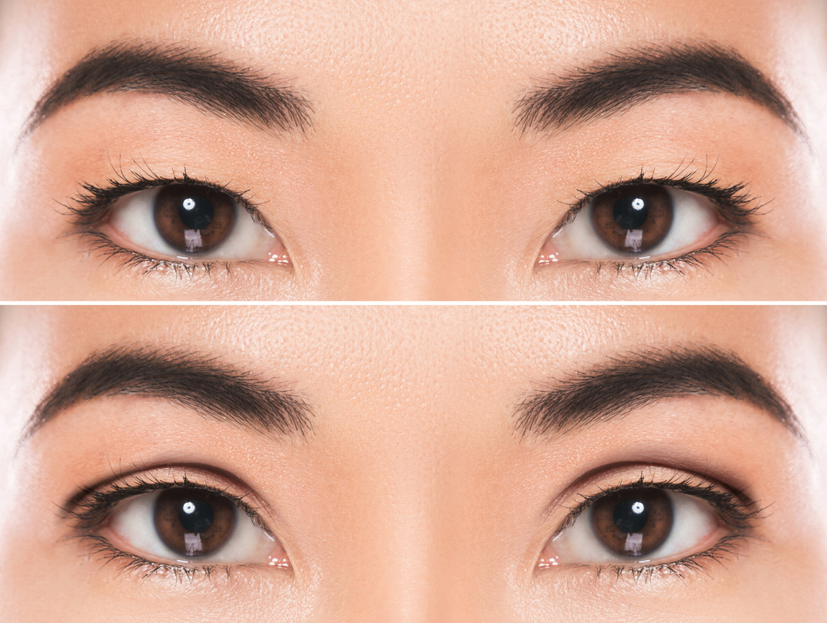 Close up a woman's eyes before and after double eyelid surgery to represent the expected recovery timeline.