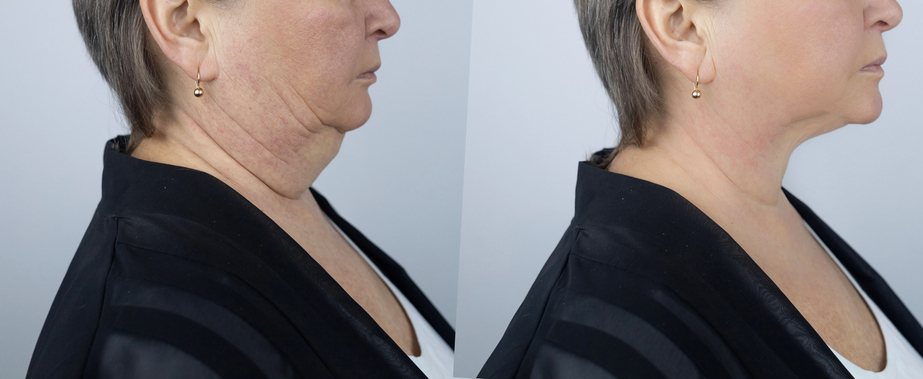 Before and After photos of a patient who has undergone neck lift surgery as the featured image for Tips for a Smooth Neck Lift Recovery