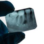 concept for 5 myths about root canals