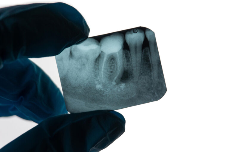 concept for 5 myths about root canals