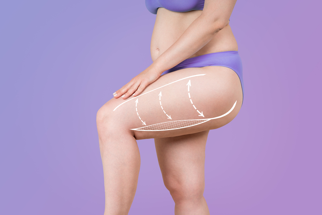 Featured image for Dismantling Myths About Thigh Lifts