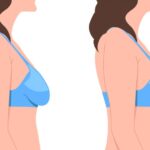 Featured image for How Long Do Breast Lift Results Last