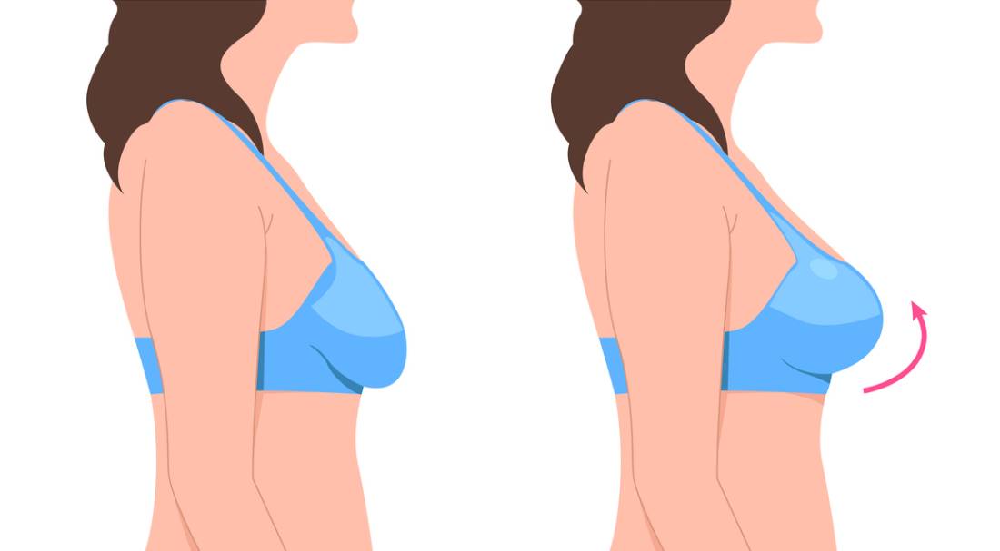 Featured image for How Long Do Breast Lift Results Last