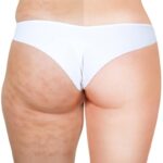 Featured image for How to Get Rid of Butt Cellulite