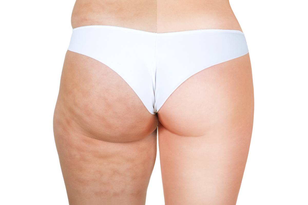 Featured image for How to Get Rid of Butt Cellulite