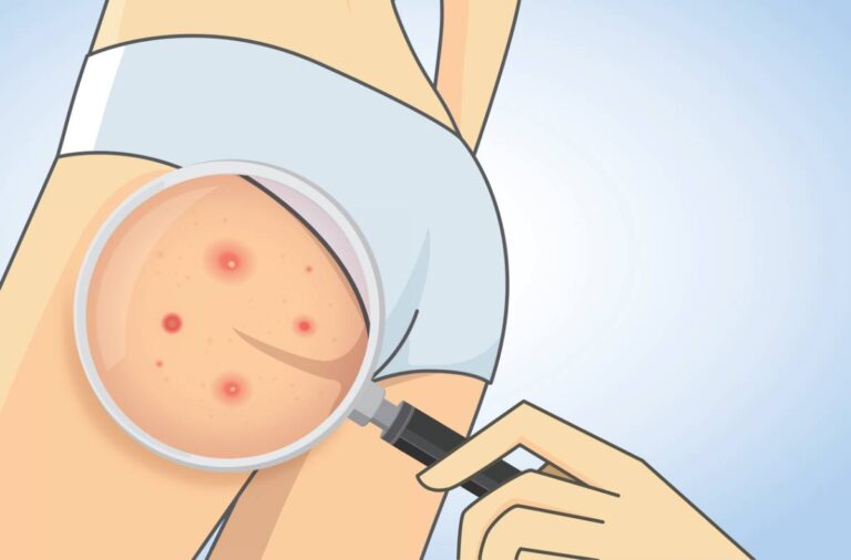 Featured image for How to Get Rid of Butt Acne Scars