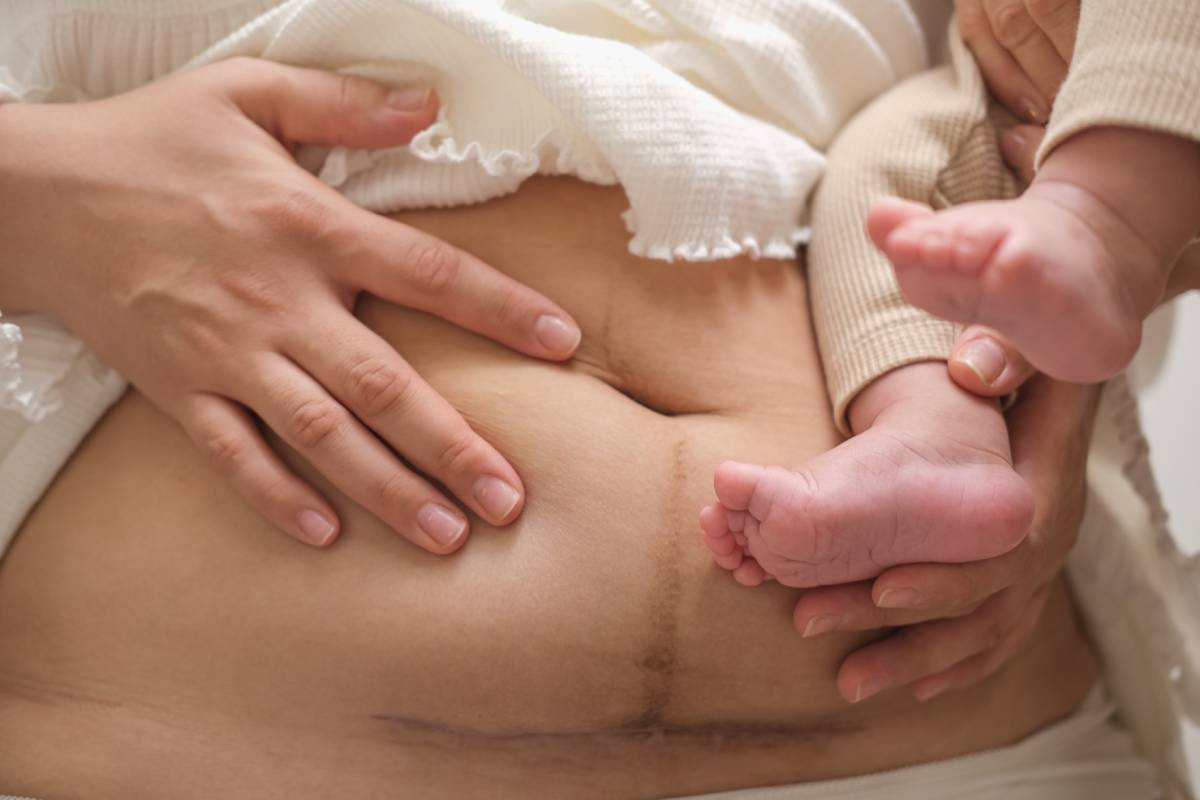 Close-up of a woman’s postpartum abdomen with loose skin as she holds her baby, representing tummy tuck after pregnancy recovery.
