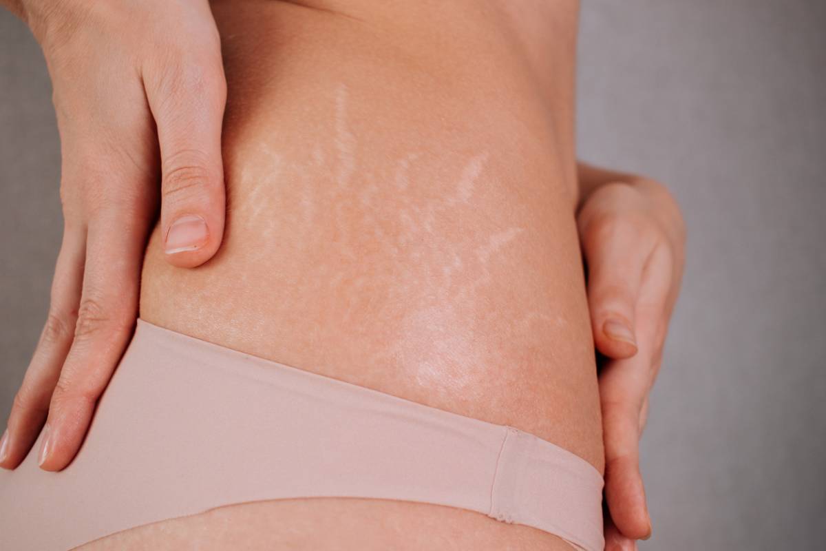 Woman touching her stretch marks.