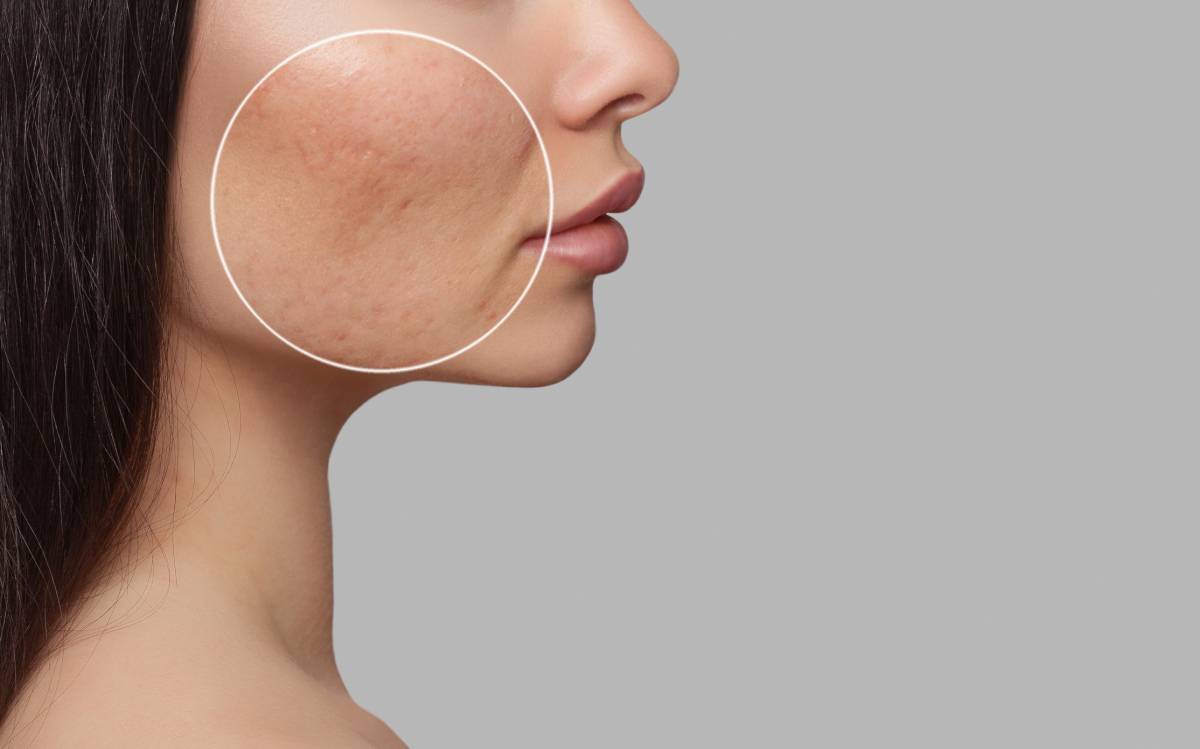 Woman showing before and after treatment for acne.