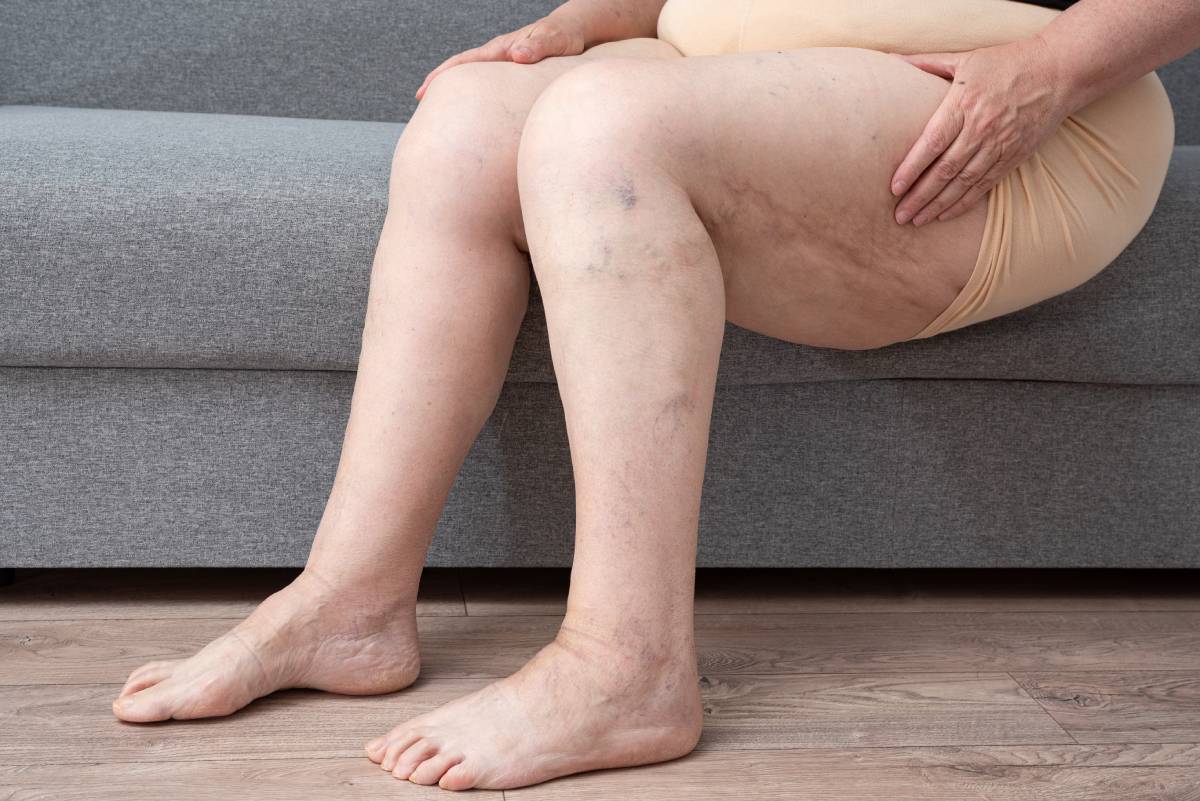 Legs of an anonymous elderly woman with vascular dilation. Veins on the legs of an overweight person, health problems.