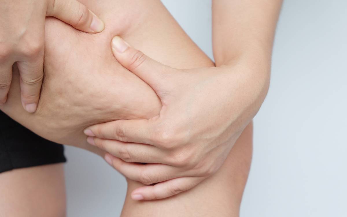 Female thighs with cellulite.