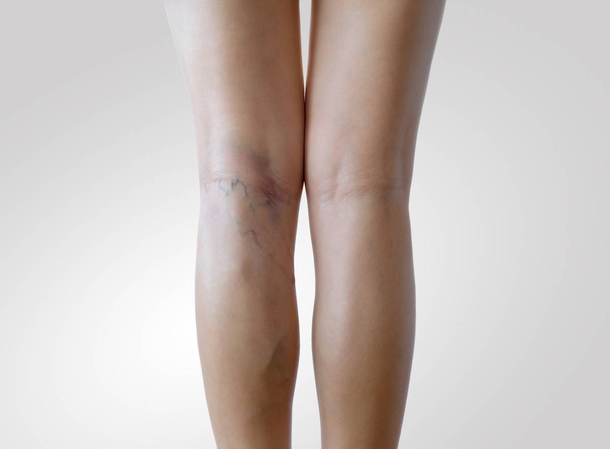 Sign of varicose veins symptoms on a legs.